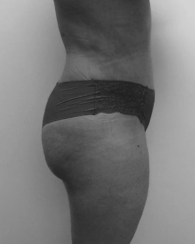 Procedure before and after - after