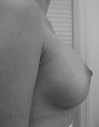 Procedure before and after - after