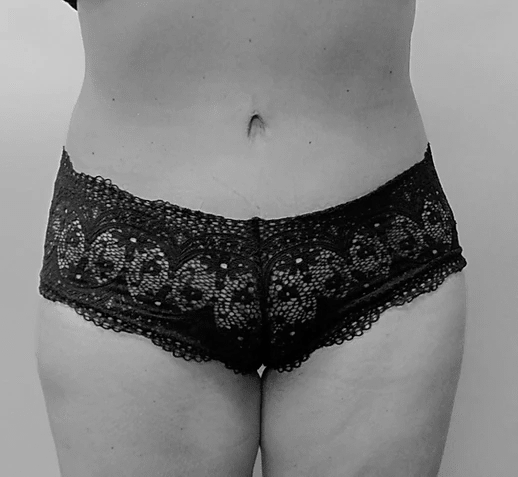 Procedure before and after - after