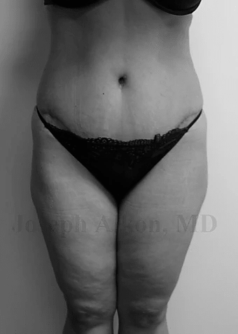 Procedure before and after - after