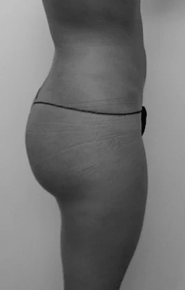 Procedure before and after - after