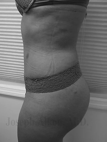 Procedure before and after - after