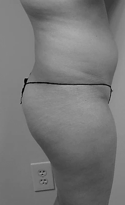 Procedure before and after - before