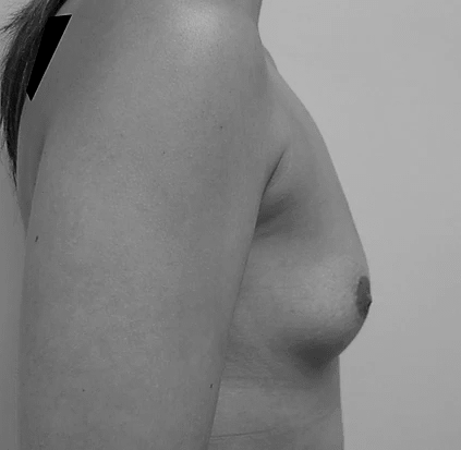 Procedure before and after - before