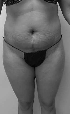Procedure before and after - before