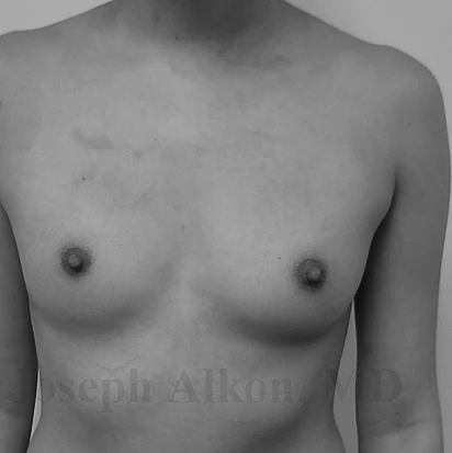 Procedure before and after - before