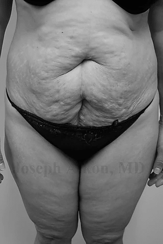 Procedure before and after - before