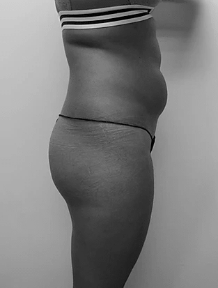 Procedure before and after - before