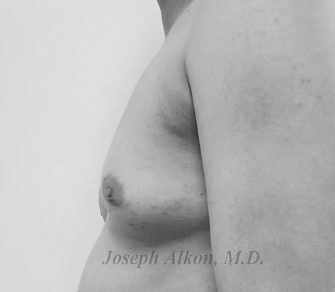 Procedure before and after - before