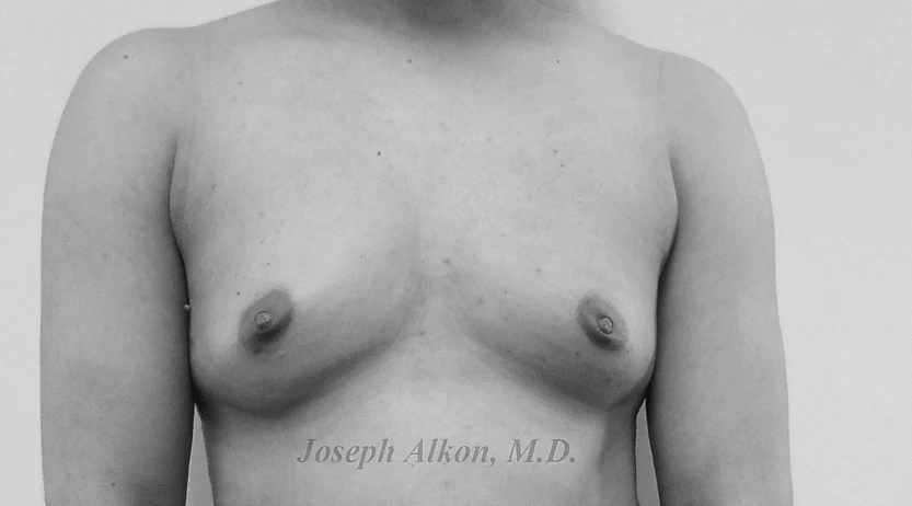 Procedure before and after - before