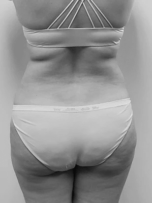Procedure before and after - before