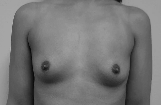 Procedure before and after - before