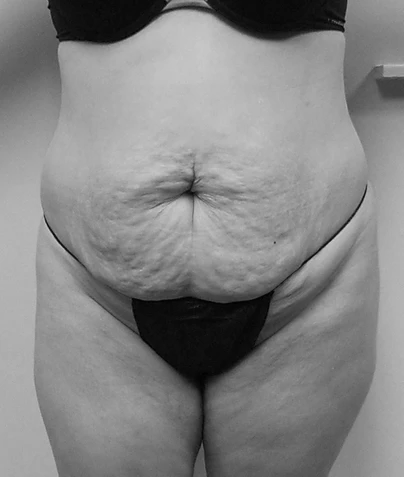 Procedure before and after - before