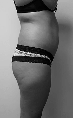 Procedure before and after - before