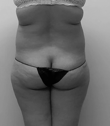 Procedure before and after - before