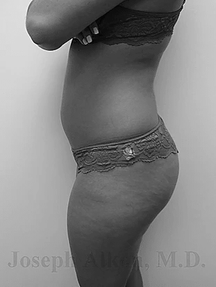 Procedure before and after - before