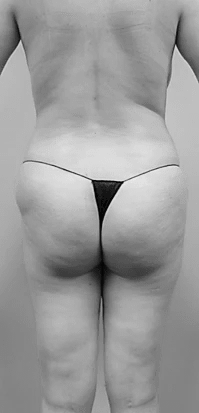 Procedure before and after - before