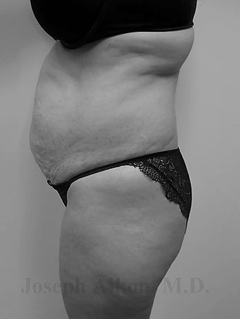 Procedure before and after - before