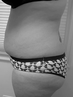 Procedure before and after - before