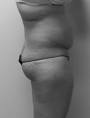 Procedure before and after - before