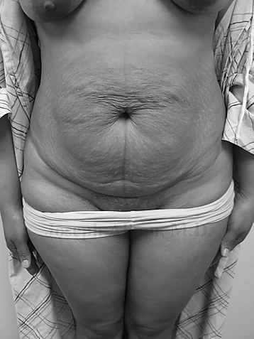 Procedure before and after - before