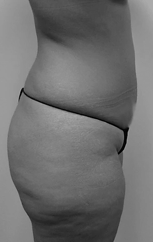 Procedure before and after - before
