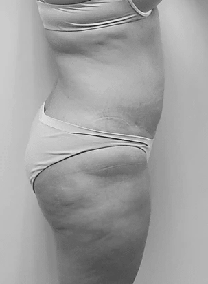 Procedure before and after - before