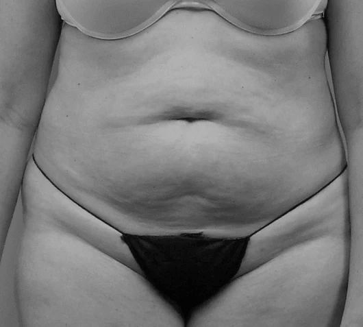 Procedure before and after - before
