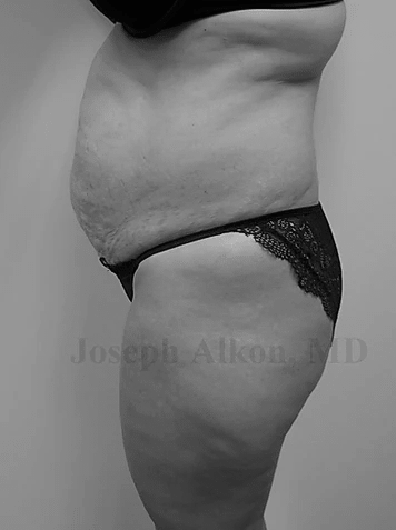 Procedure before and after - before