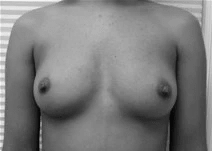 Procedure before and after - before