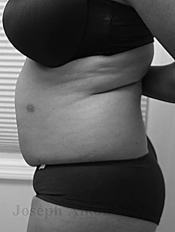 Procedure before and after - before
