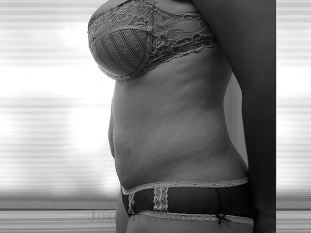 Procedure before and after - before