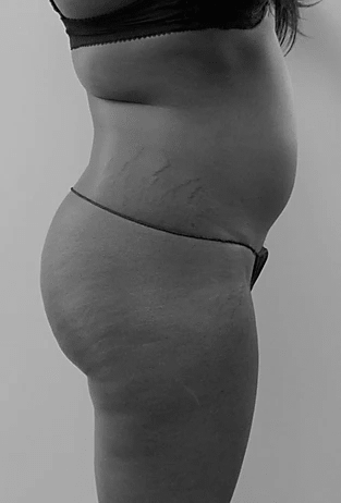 Procedure before and after - before