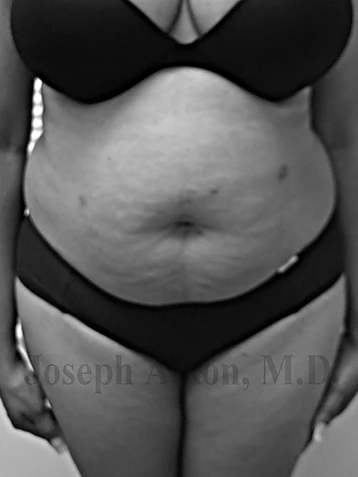 Procedure before and after - before