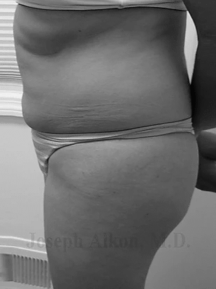 Procedure before and after - before