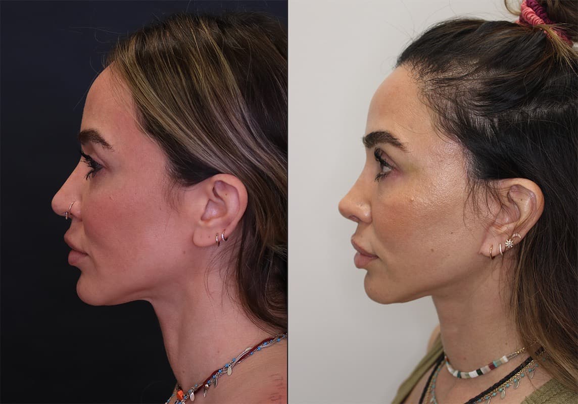 Facelift before and after - after