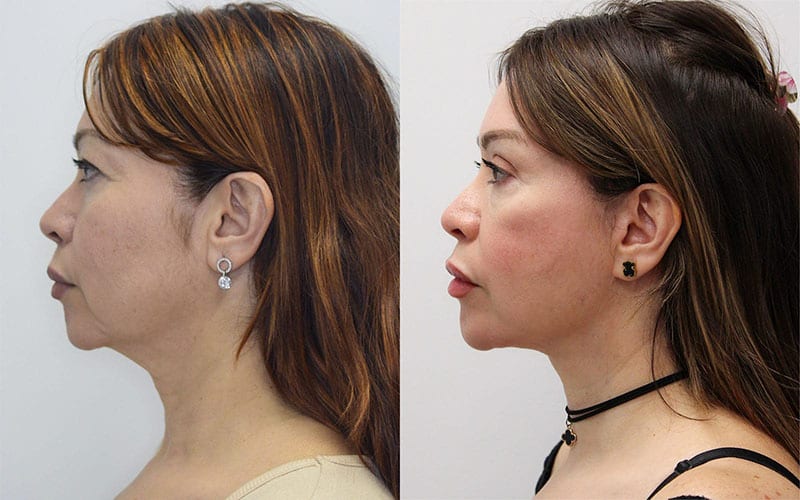 Facelift before and after - after