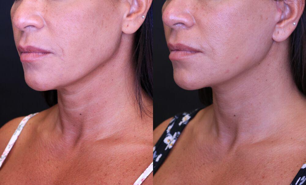 Neck Lift before and after - after