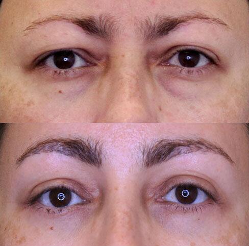 Blepharoplasty before and after - after