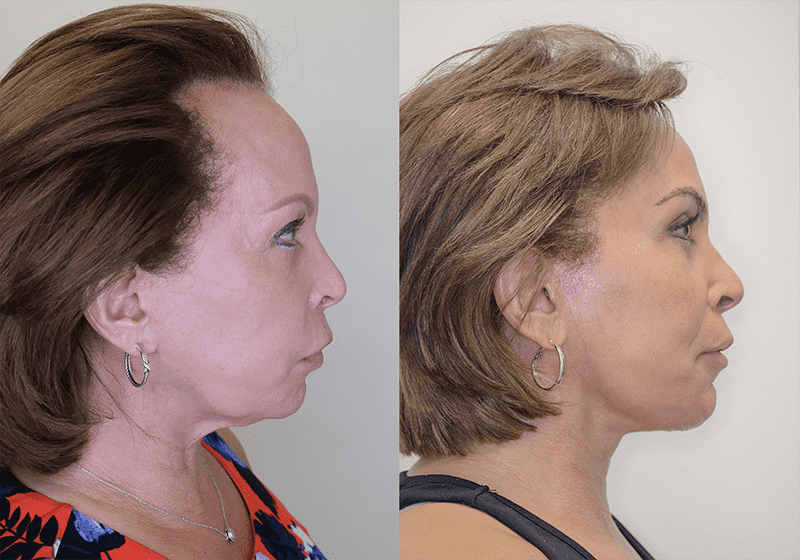 Facelift before and after - after