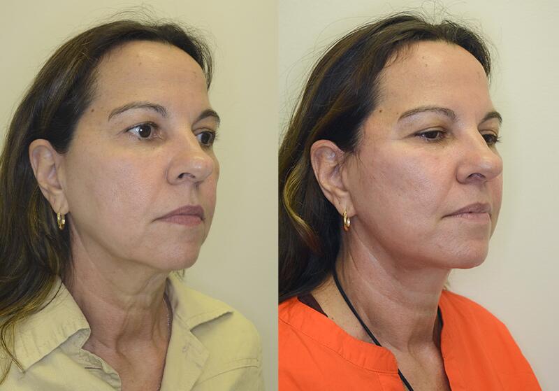 Facelift before and after - after