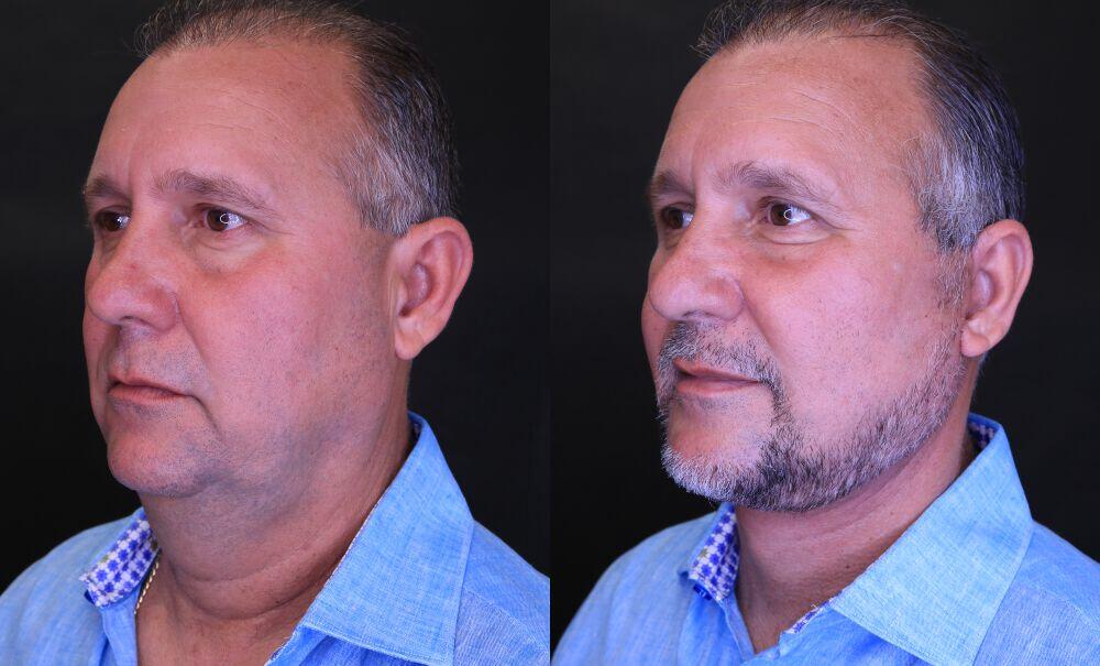 Neck Lift before and after - after