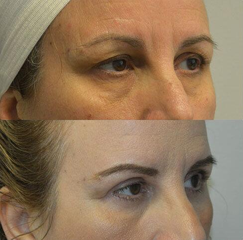 Blepharoplasty before and after - after