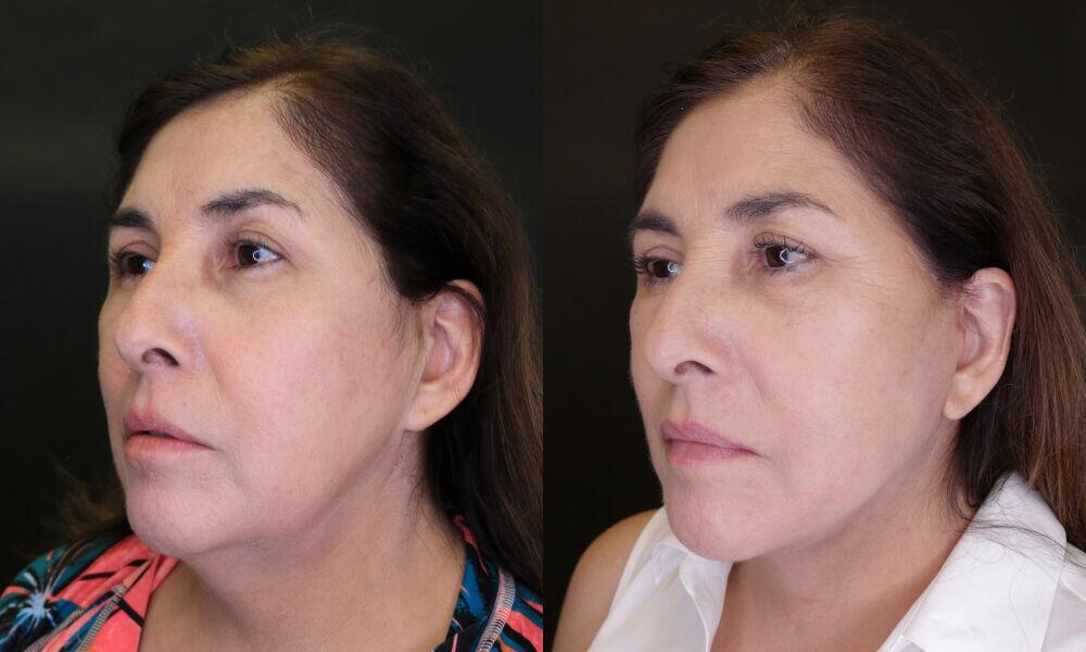 Neck Lift before and after - after