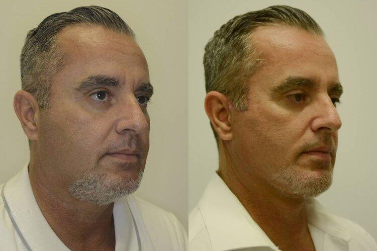 Facelift before and after - after