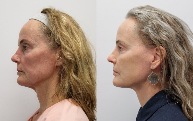 Facelift before and after - after