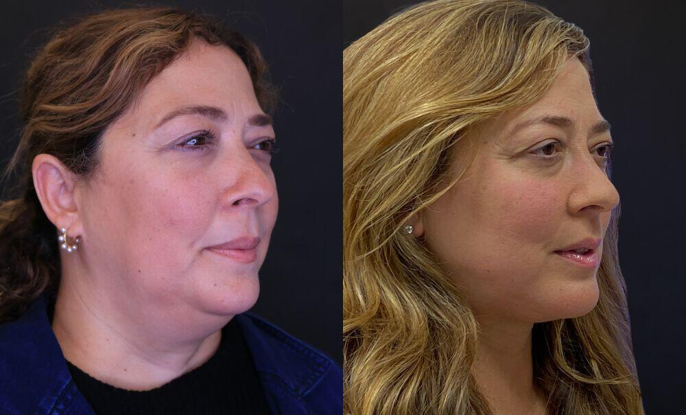 Facelift before and after - after