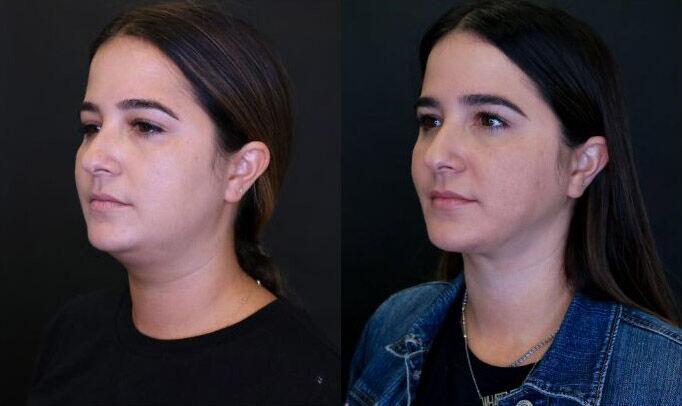 Liposuction before and after - after
