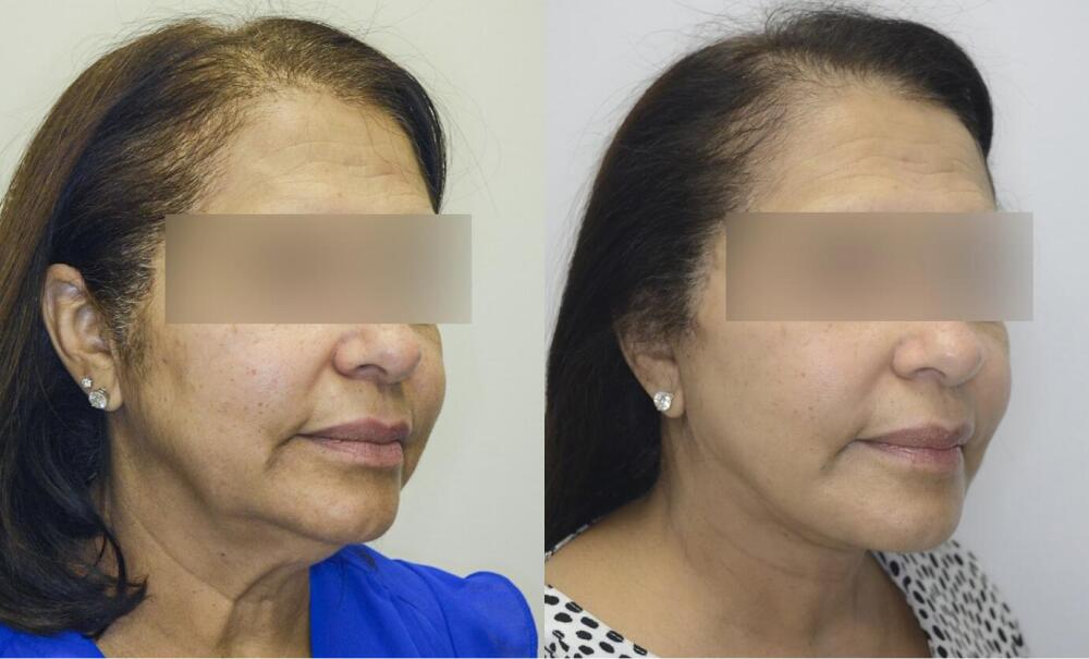 Facelift before and after - after