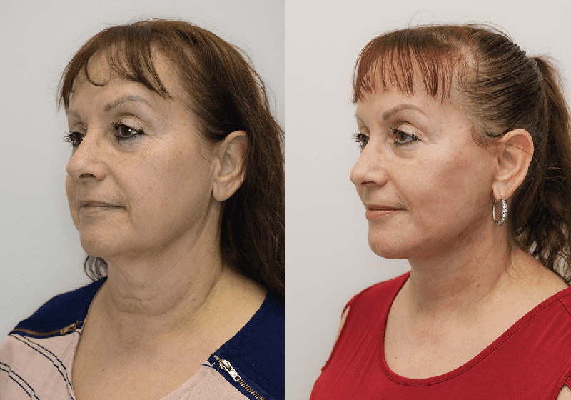 Facelift before and after - after